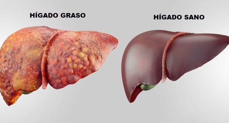 evitar la cirrosis hepática de forma natural