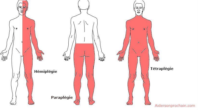 Tratamiento natural de la hemiplejia