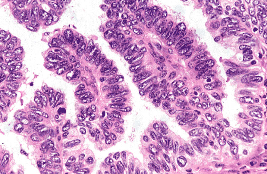 CAUSES OF VERGE ADENOCARCINOMA: NATURAL TREATMENT