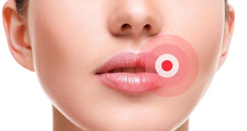 Herpès : causes, symptômes et traitement naturel