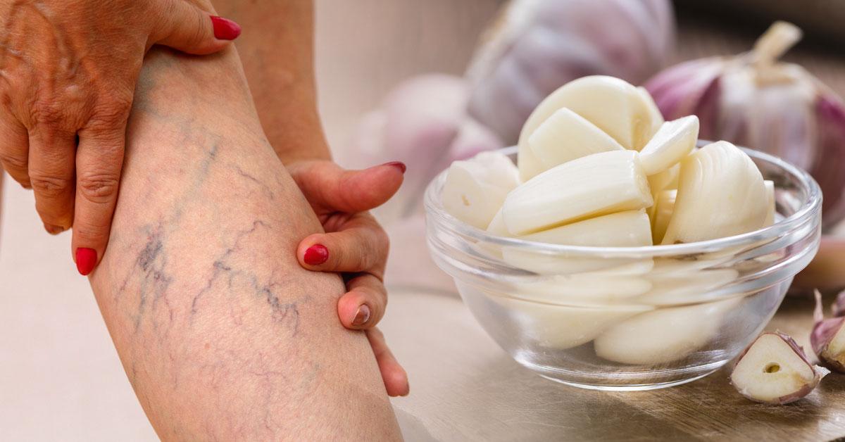 1560534816 archive 4 remedios naturales eliminar varices