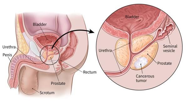 PROSTATE CANCER AND IMPOTENCE: Natural Treatment
