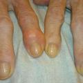 4 RECIPES TO FIGHT AGAINST ARTHROSIS