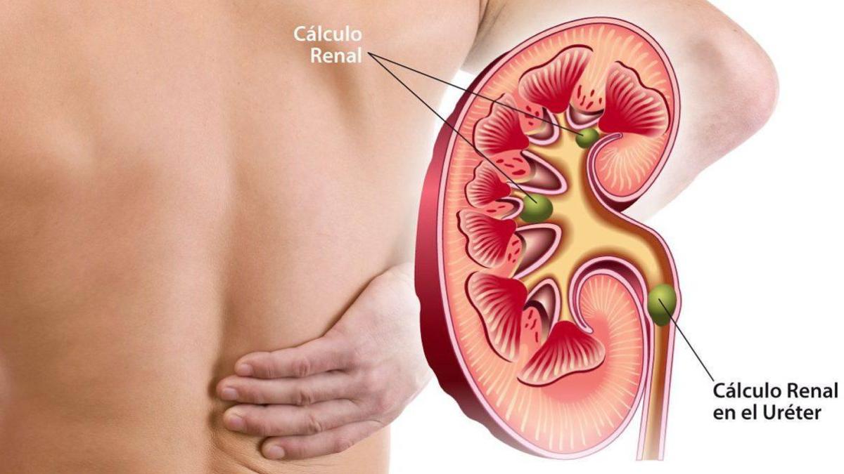 plantas medicinales para los rinones y vias urinarias
