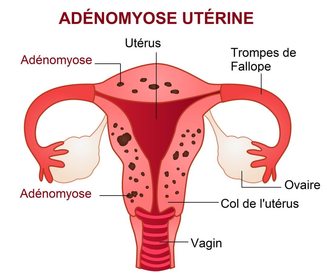 ADENOMYOSE TRAITEMENT NATUREL : Plantes et remèdes