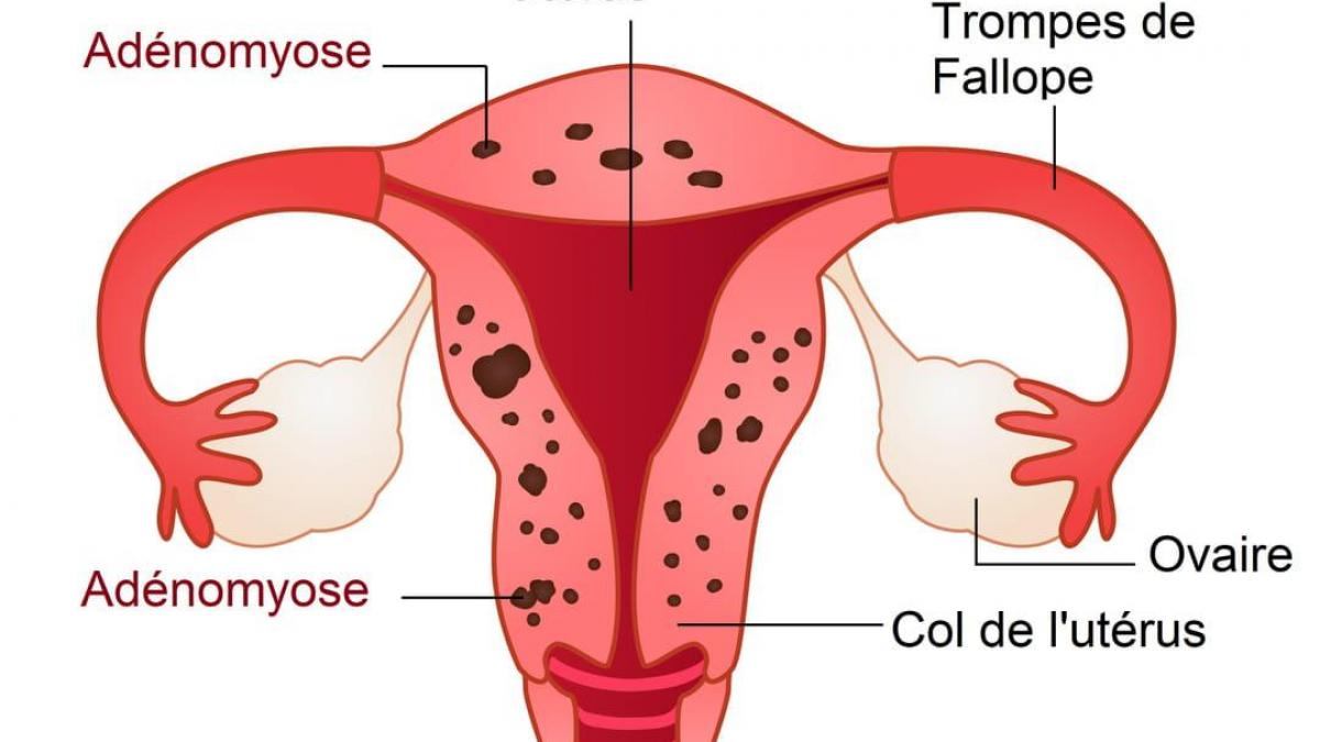 ADENOMYOSE TRAITEMENT NATUREL : Plantes et remèdes