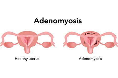 ADENOMYOSIS NATURAL TREATMENT: The experts at Dawasanté