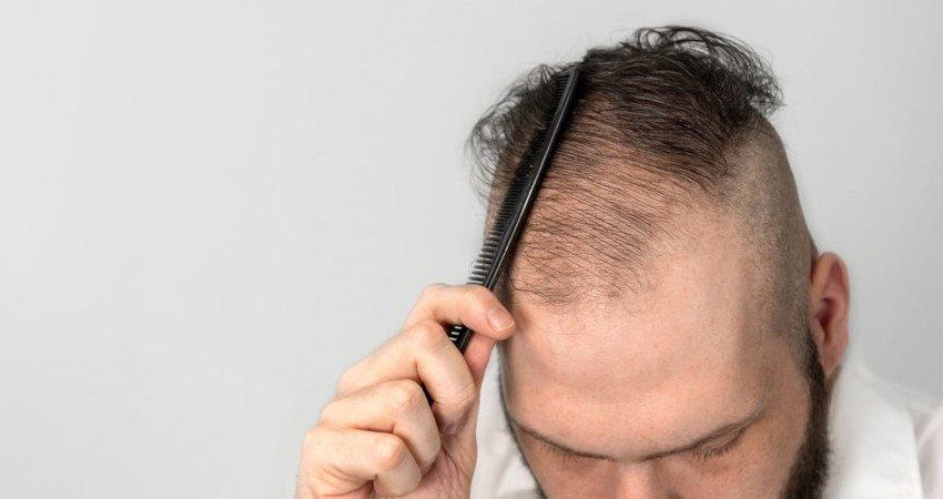 TRAITEMENT NATUREL POUR L'ALOPECIE