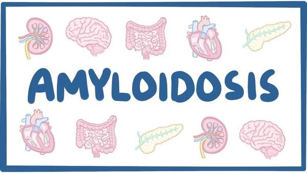 AMYLOSIS: CONVENTIONAL TREATMENT AGAINST NATURAL HERBAL REMEDIES