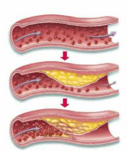 L'athérosclérose: causes, symptômes et remèdes