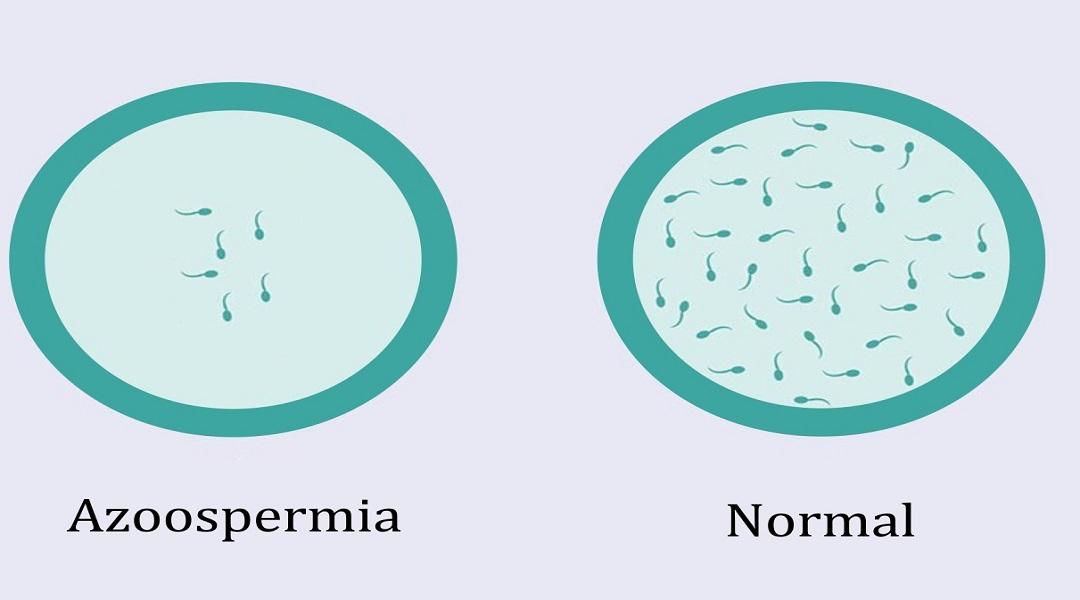 AZOOSPERMIA CAUSES: natural treatment