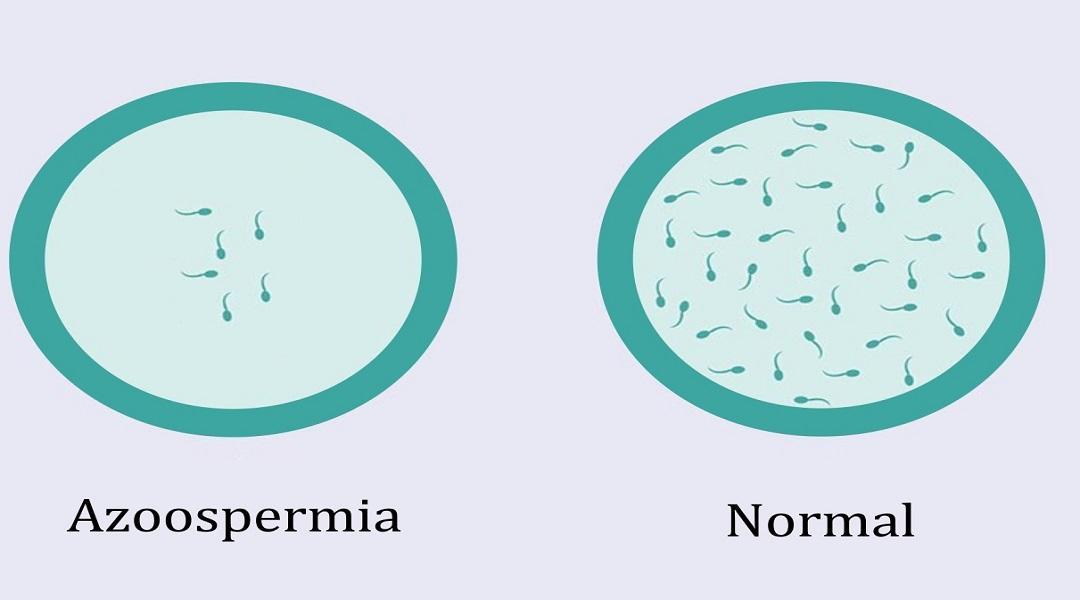 AZOOSPERMIA CAUSES: natural treatment