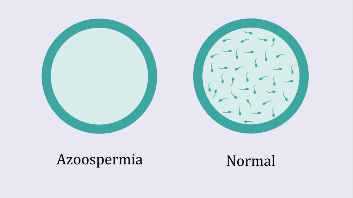 AZOOSPERMIE GROSSESSE : Traitement naturel