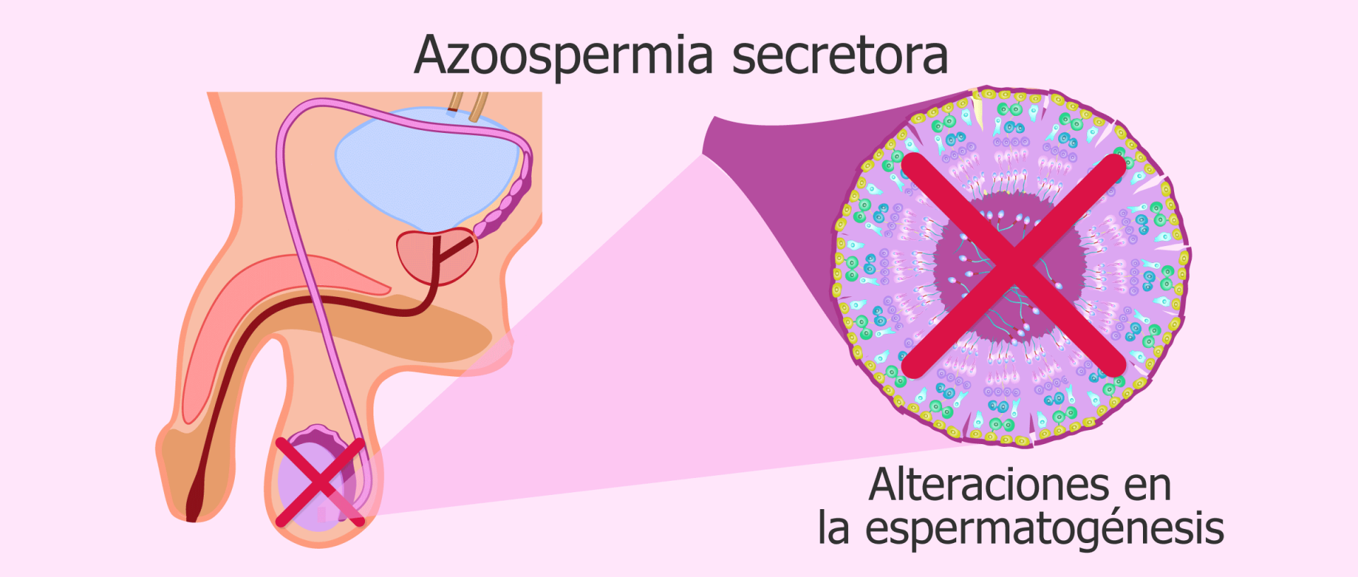 Azoospermia secretora