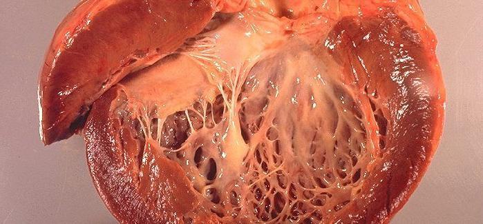 Natural remedies to treat amyloidosis