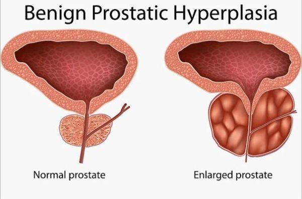 HYPERTROPHIE PROSTATIQUE: Traitement naturel