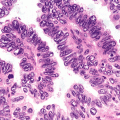 L'ADÉNOCARCINOME DE LA  VERGE : TRAITEMENT NATUREL