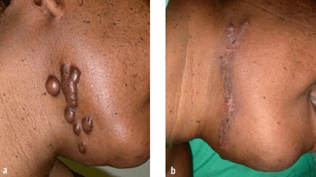 TREATMENT OF KELOIDS WITH HONEY