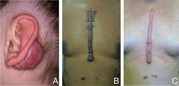 Natural solution and medical treatments for keloids