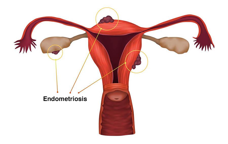 ENDOMETRIOSIS TREATMENT REGIME: Natural treatment