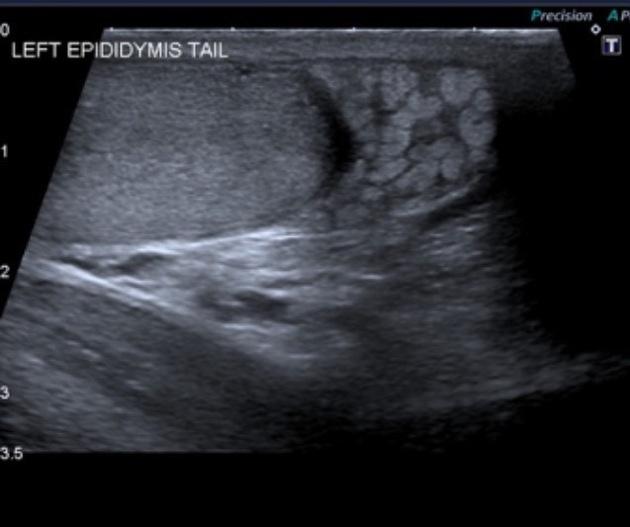 BEST HERBAL NATURAL TREATMENT FOR VARICOCELE