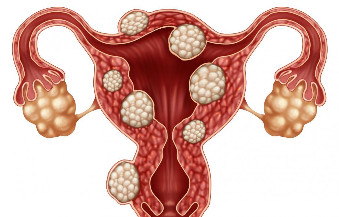 Fibroids 1 