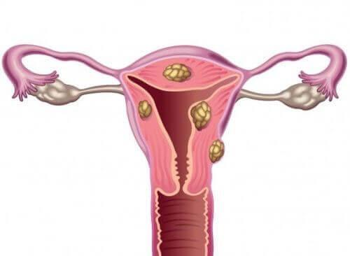 Fibroids 1