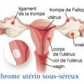 Fibromes cancer