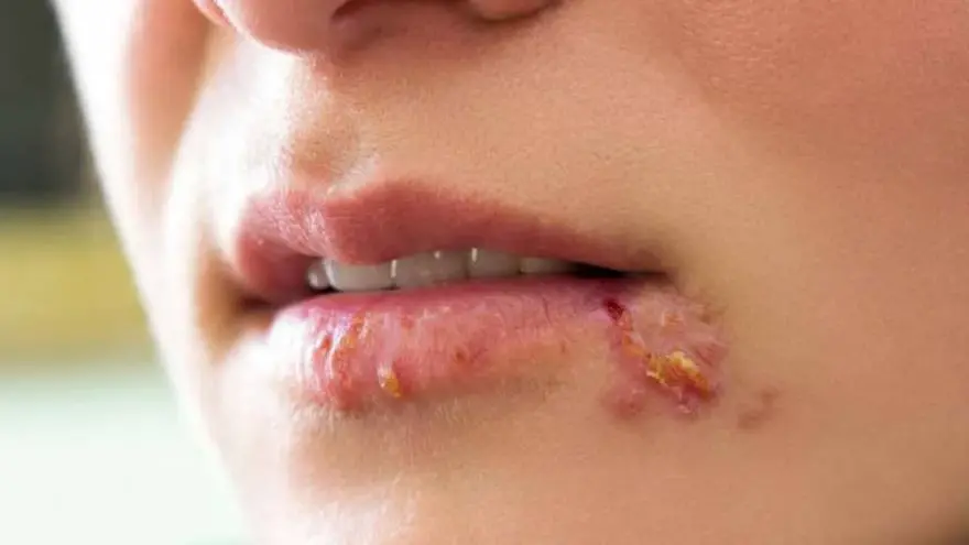 TEAS TO TREAT HERPES