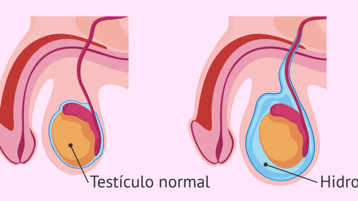 Remedios caseros para la hidrocele testicular