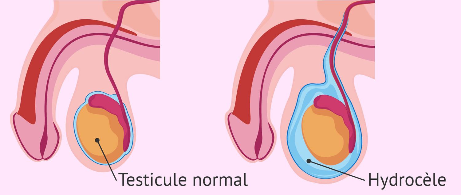 Hydrocele testis