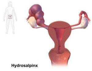 Hydrosalpinx 1