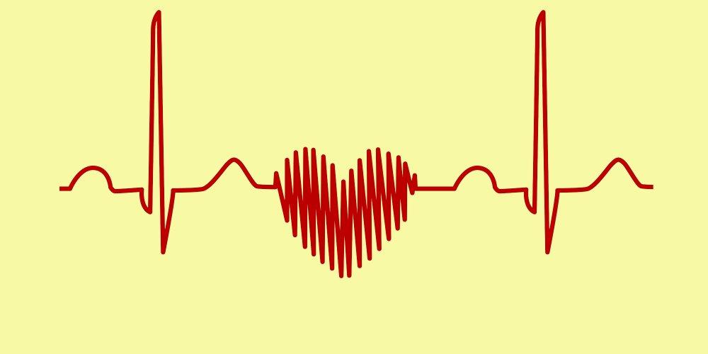 Hypertension coeur ecg 1