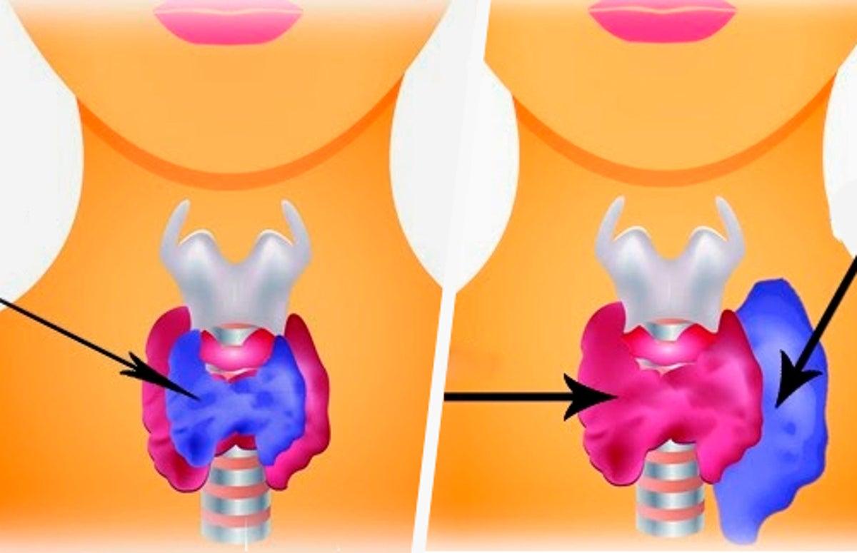 Hypothyroidie et hyperthyroidie