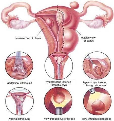 Hysteroscopic myomectomy polypectomy