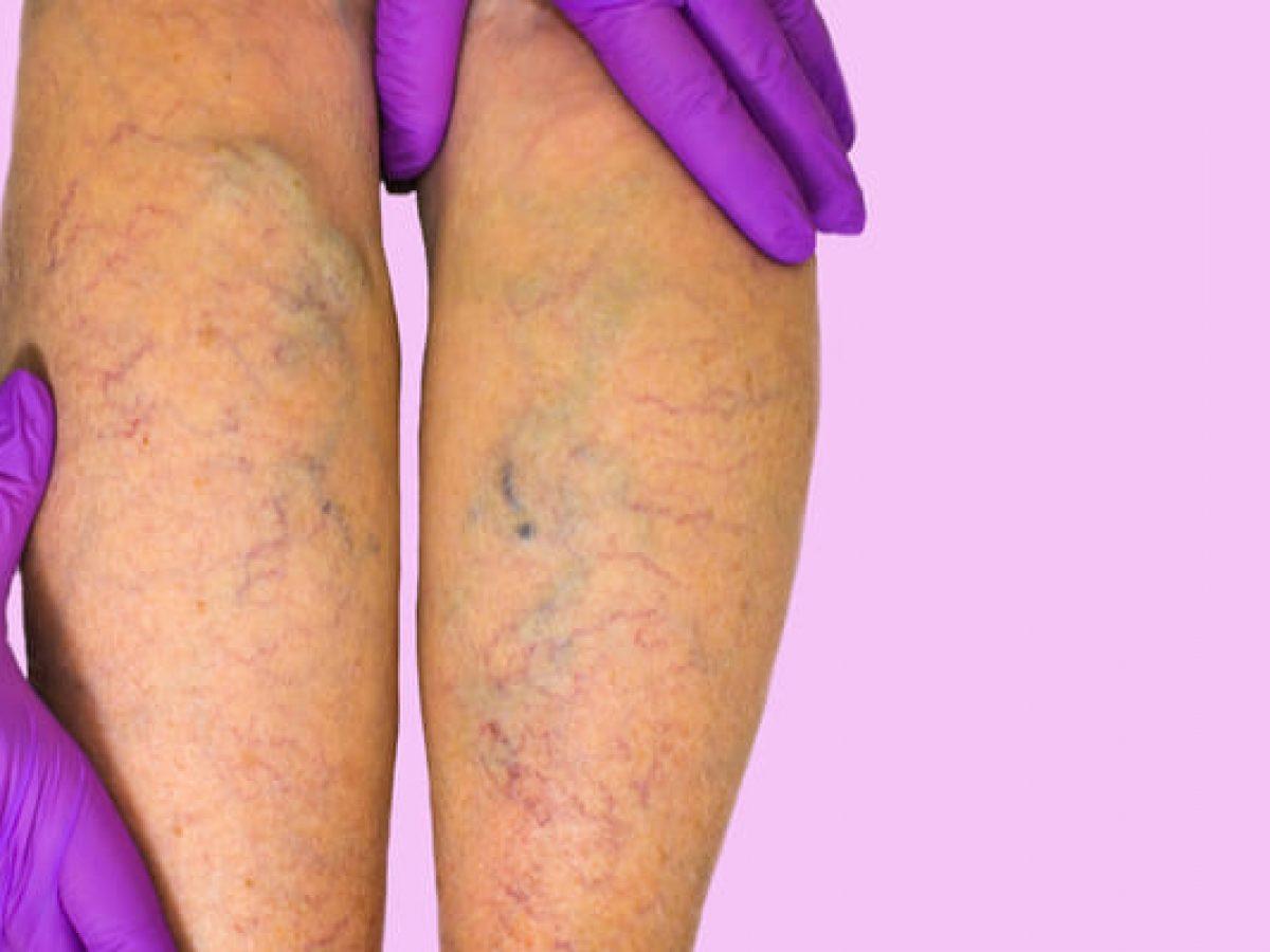 Insuficiencia venosa 1200x900