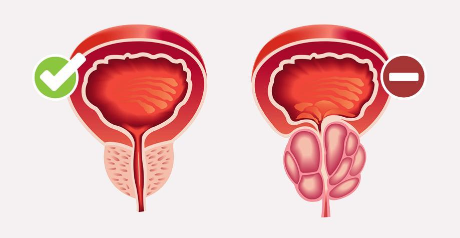 LA TOMATE ET L'HYPERTROPHIE PROSTATIQUE