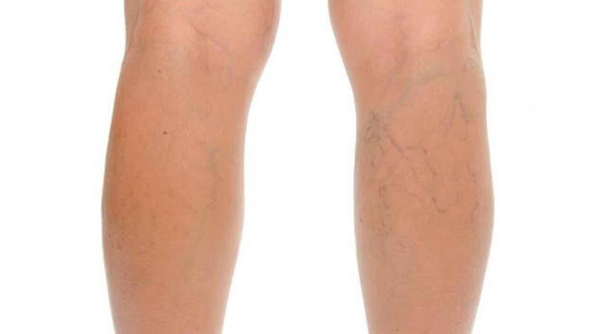 9 home remedies for varicose veins