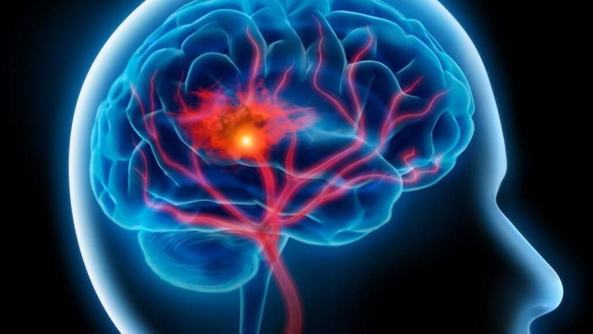 plantas para tratar hemiplejia