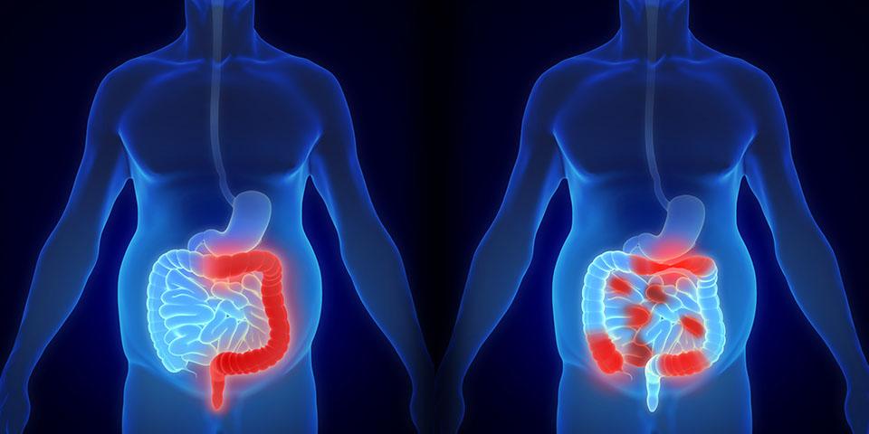 Remèdes naturels  pour guérir la maladie de Crohn définitivement
