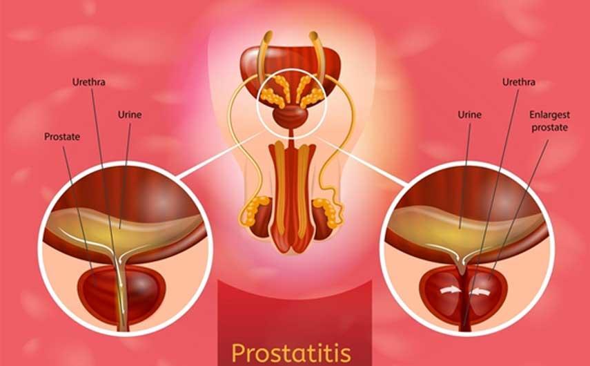 CHRONIC BACTERIAL PROSTATITIS: Natural treatment