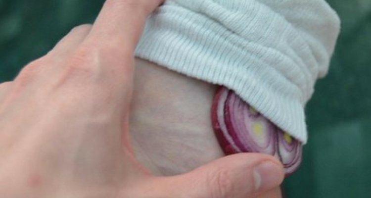 L'oignon pour traiter les  varices dans les jambes