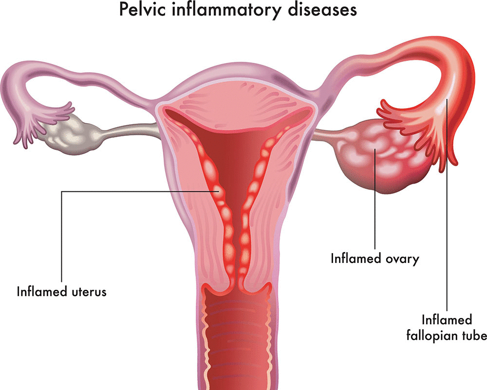 PELVIC INFLAMMATORY DISEASE