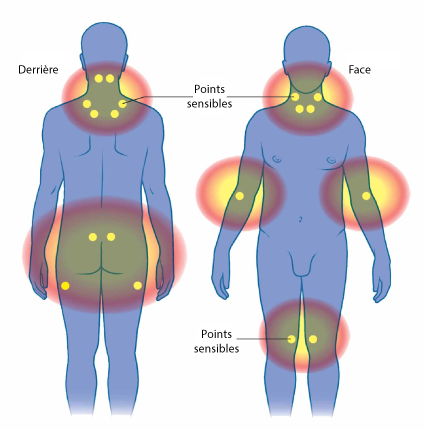 Comment éviter un handicape avec le Fibromyalgie