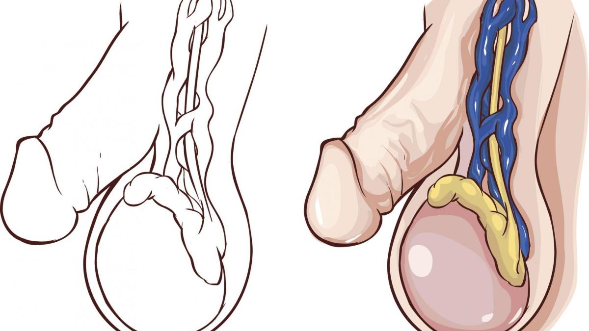 plantas medicinales para la varicocele
