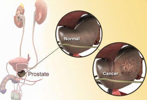 LE CANCER DE LA PROSTATE ET FERTILITÉ : Traitement naturel
