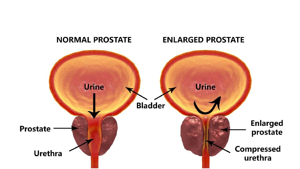 PROSTATE CANCER AND RADIATION THERAPY
