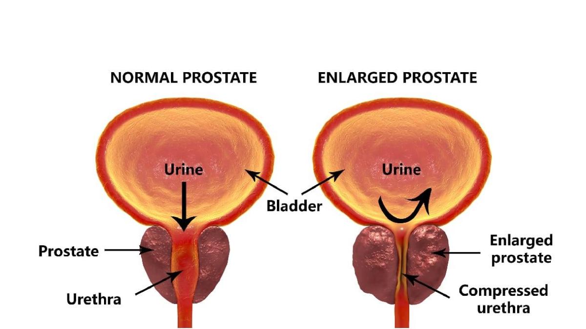 PROSTATE CANCER AND RADIATION THERAPY