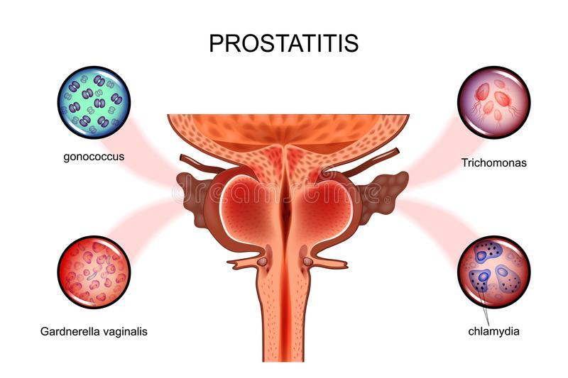 Prostatitis sexual infections vector illustration prostate 107732945