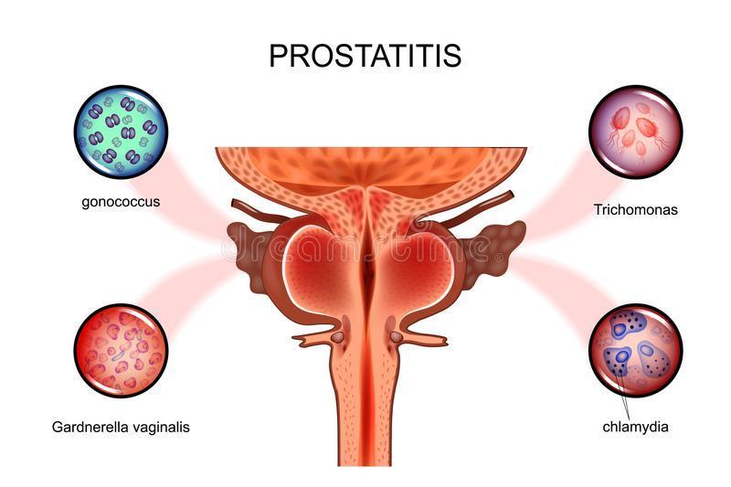 RELATIONSHIP BETWEEN PROSTATITIS AND CHLAMYDIA: Natural treatment
